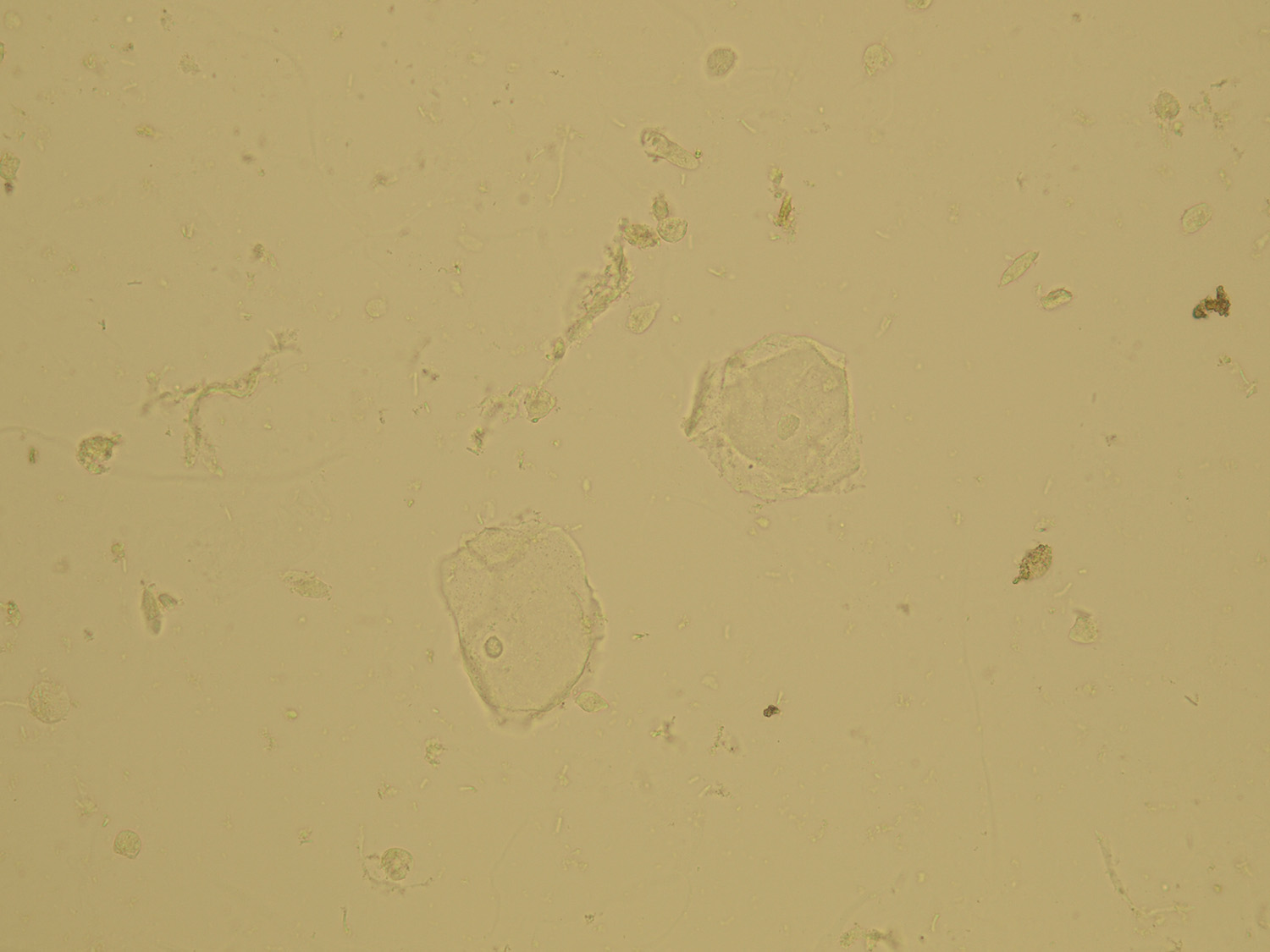 Squamous Epithelial Cells in Urine - healthheartycom