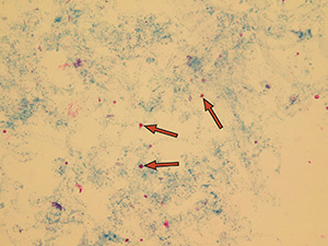 Dysmorphic erythrocytes – acanthocytes