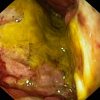 Tumorem infiltrovaná žaludeční stěna