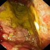 Tumorem infiltrovaná žaludeční stěna