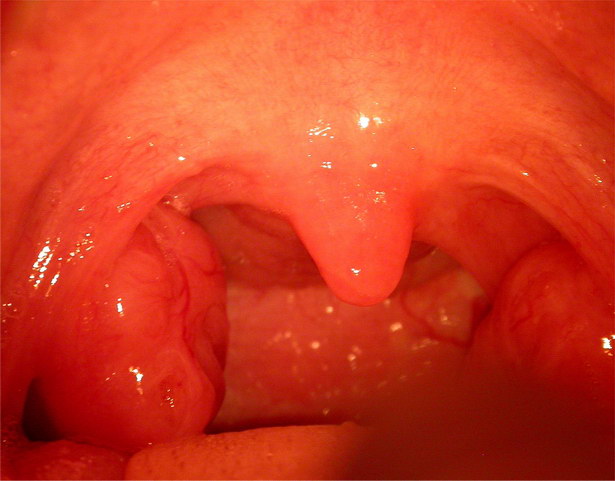 Hypertrofie patrových tonsill, Adenoidní vegetace