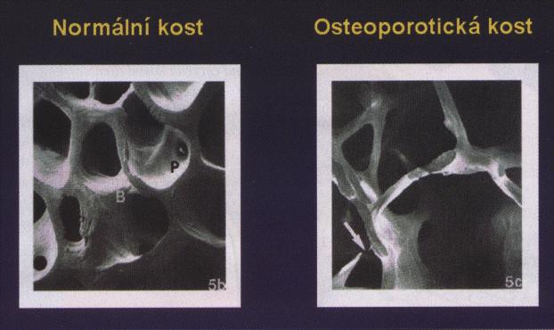 Úbytek kostních trámců při osteoporóze.