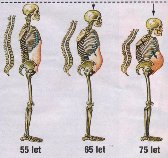 Změny tvaru páteře v důsledku osteoporózy s přibývajícím věkem.