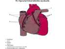 Operační řešení infarktu myokardu