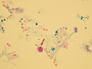 Leukocytes including macrophage with phagocyted bacteria (arrow)