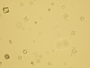 Calcium oxalate – monohydrate (oval form) and dihydrate