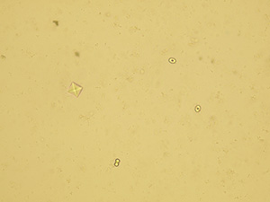 Calcium oxalate – monohydrate (oval form) and dihydrate