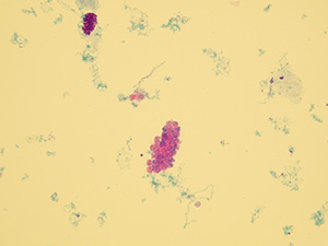 Pseudoválec – shluk leukocytů