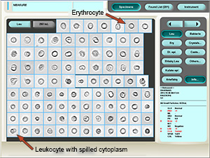 Leukocytes (glittering cells) mixed with erythrocytes in the leukocyte category