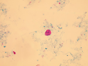 Transitional epithelial cell with two nuclei