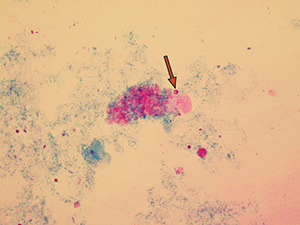Dysmorphic erythrocyte – codocyte
