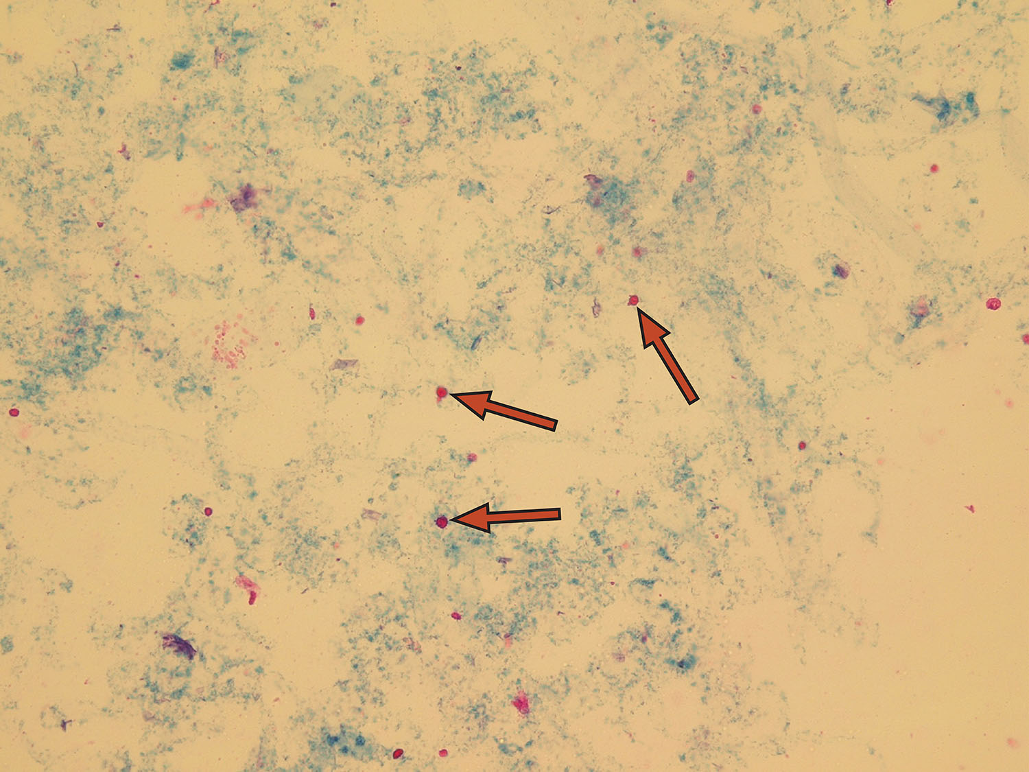 Erythrocytes Rbcs Microscopic Analysis Of Urine Faculty Of Medicine Masaryk University 5788