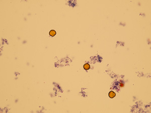 ammonium biurate crystals in urine