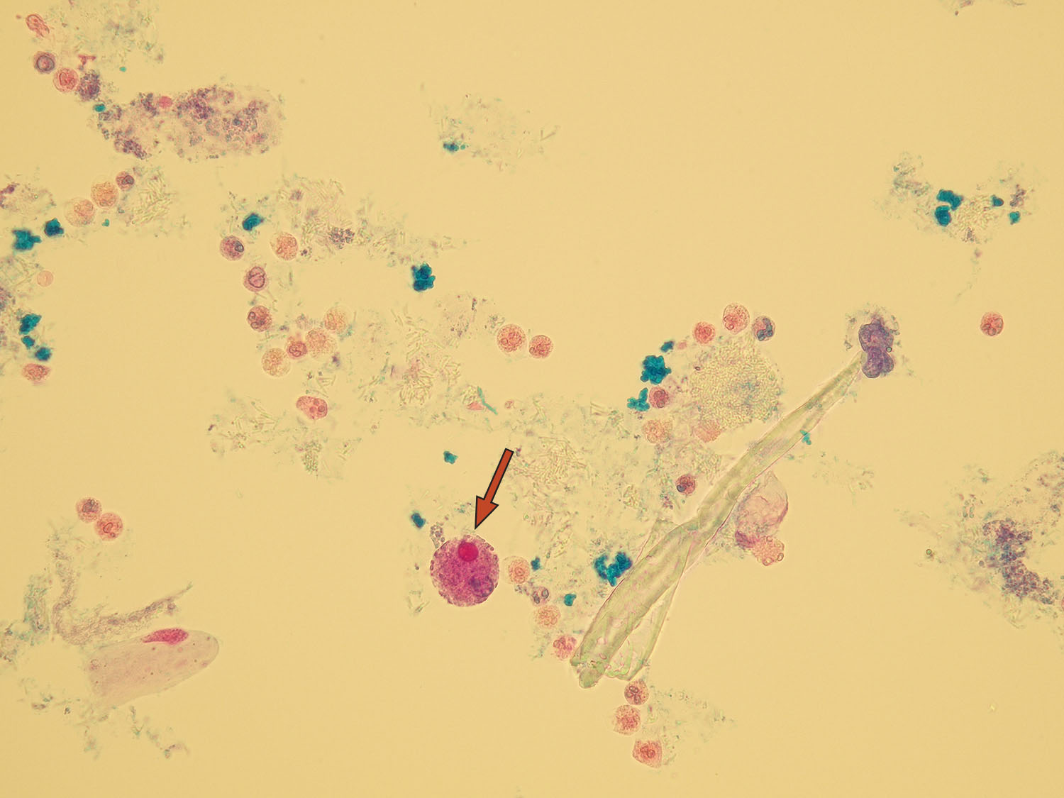 Leukocytes (WBCs) | Microscopic Analysis of Urine | Faculty of Medicine