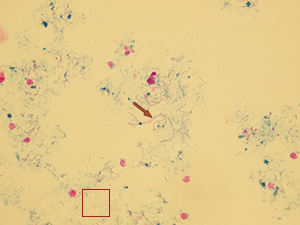 Cocci (detail) and protoplast bacteria (arrow) – stained after dyeing