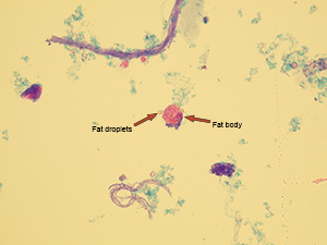 Macrophage and fat dropplets