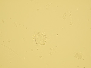 Makrofág s tukovými kapénkami a spermiemi