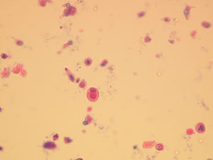 Atypical cells