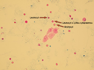 Leukocyty (třpytivé buňky) vedle erytrocytu