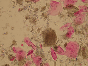 Fecal particles (brown elements) with squamous cells