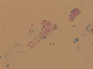 Hyaline cast with fat inclusions of fat droplets