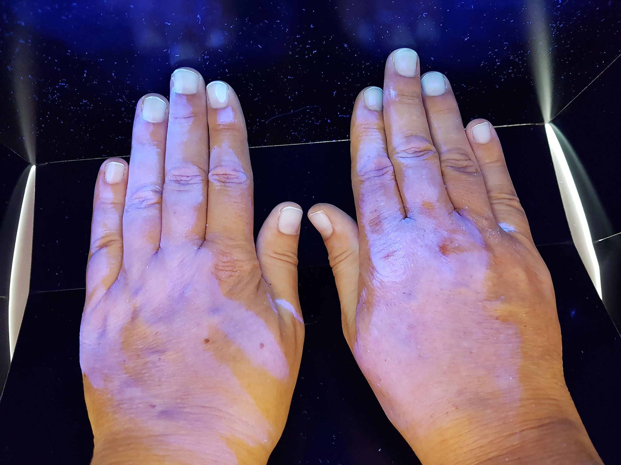 Nedostatečné provedení hygienické dezinfekce rukou (testování pod zdrojem ultrafialového světla)