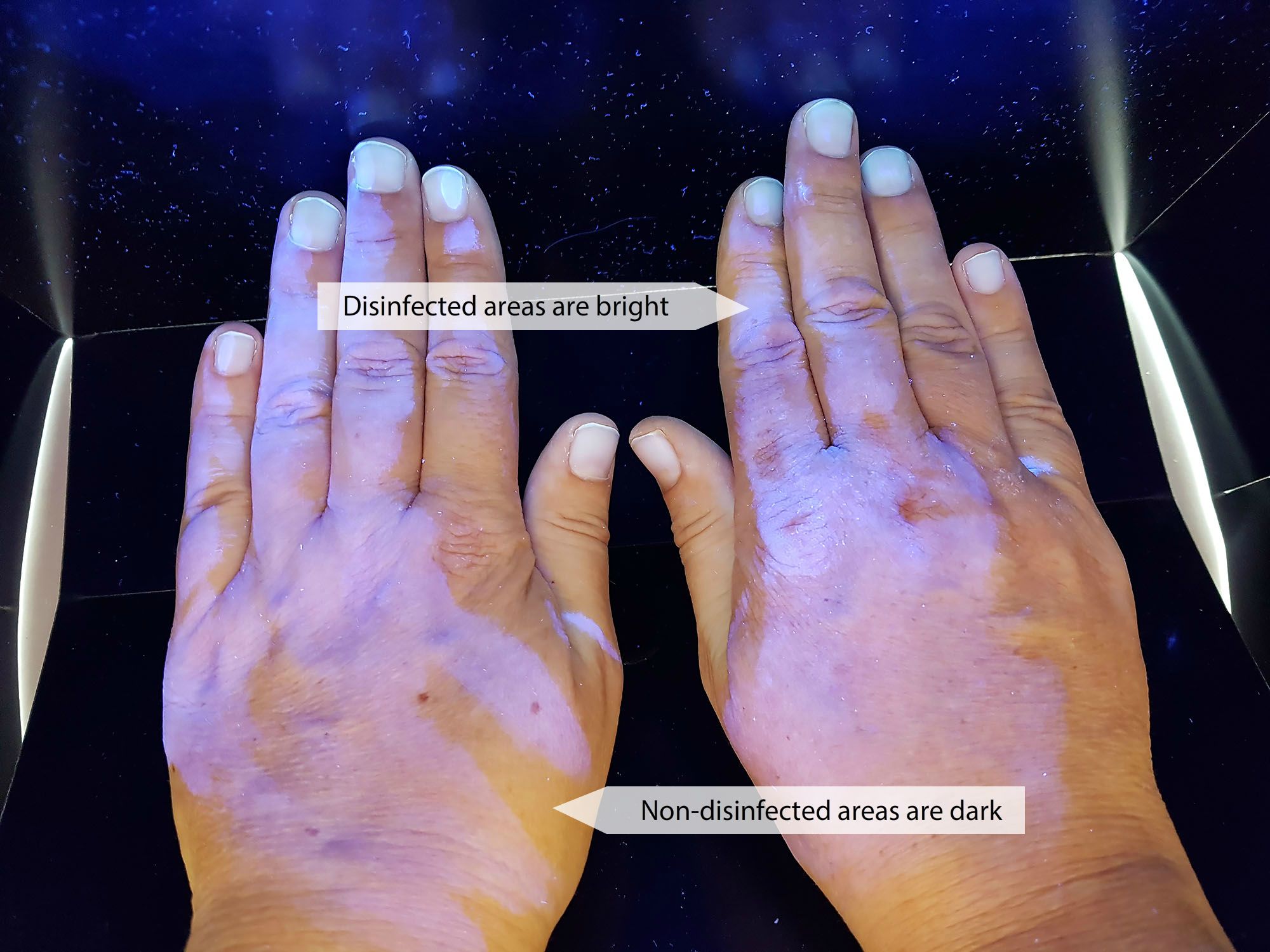 Insufficient performance of hand hygienic disinfection (testing under ultraviolet light source)
