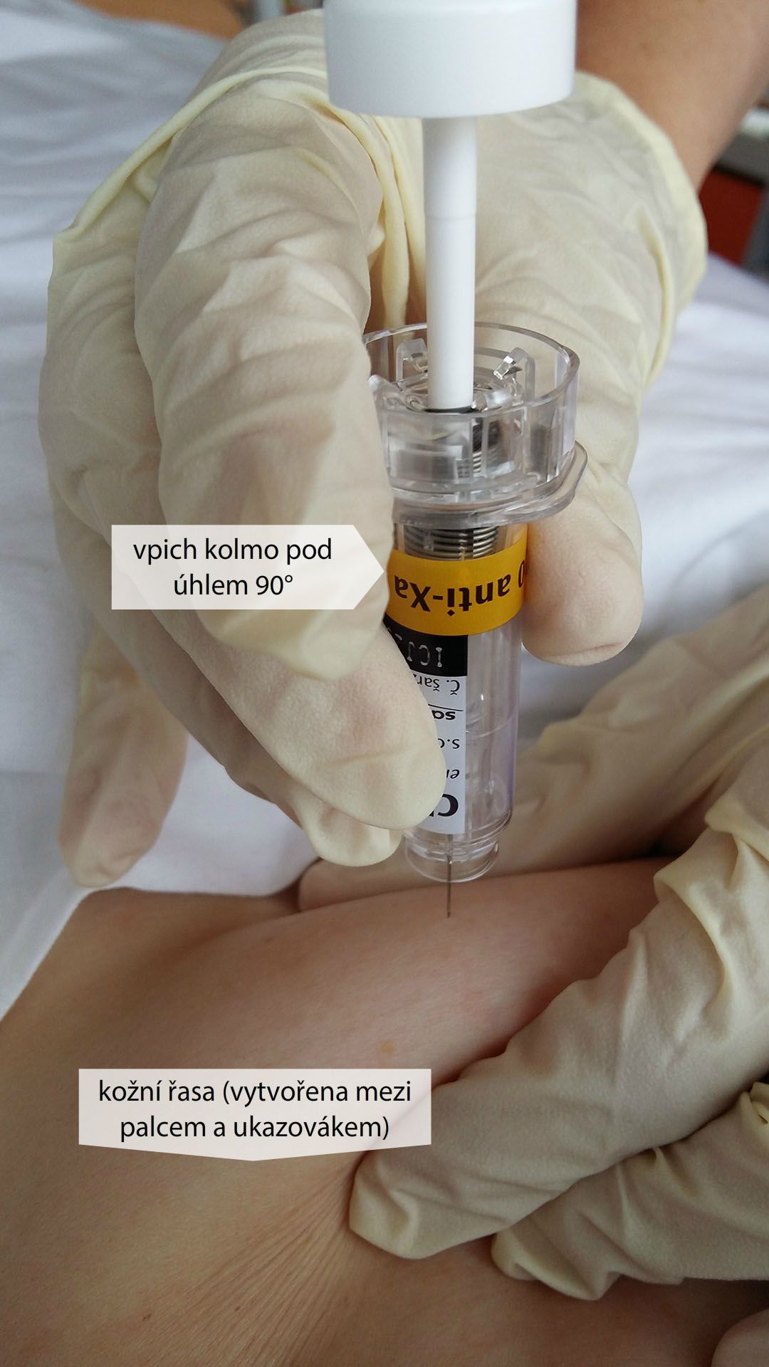 Aplikace s.c. injekce do břicha – nízkomolekulární heparin