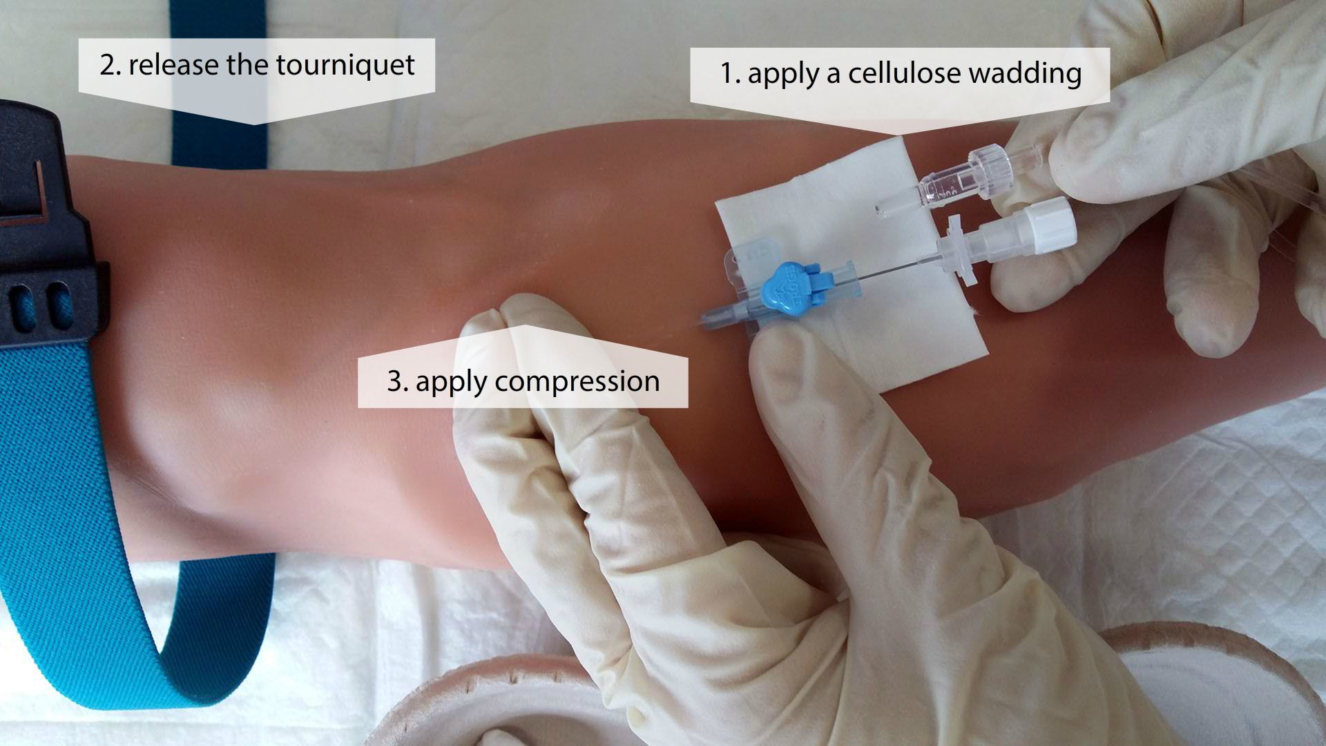 Extraction of the stylet 1