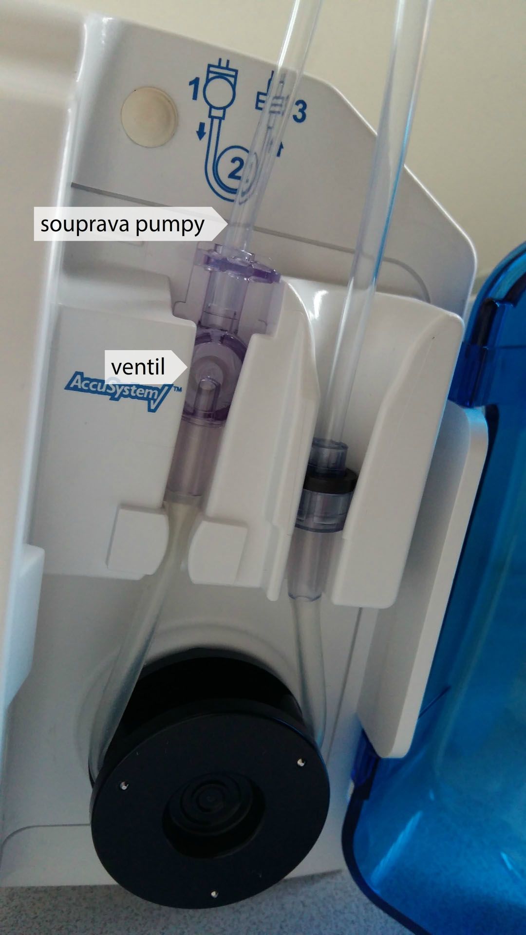 Enterální pumpa – založení soupravy pumpy