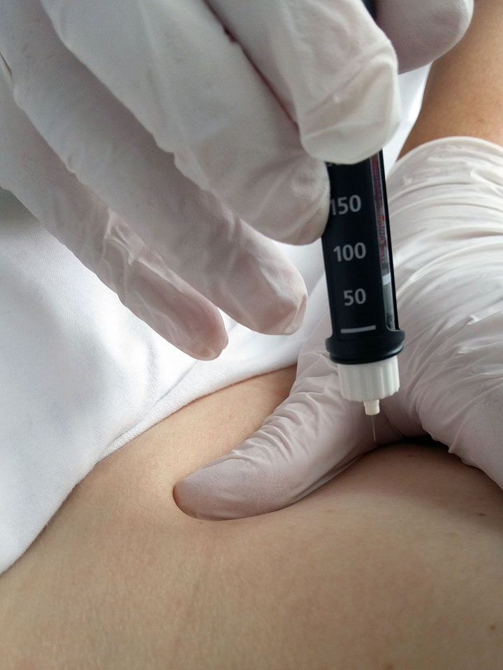 Aplikace s.c. injekce inzulinovým perem do břicha