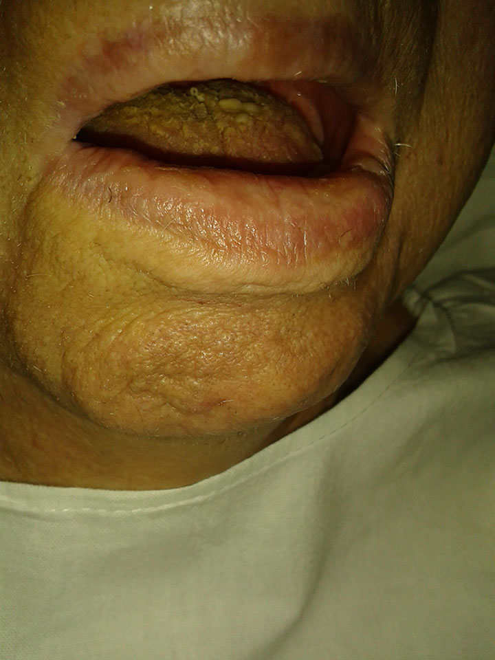 Zanedbaný stav hydratace a péče o dutinu ústní u hospitalizovaného pacienta