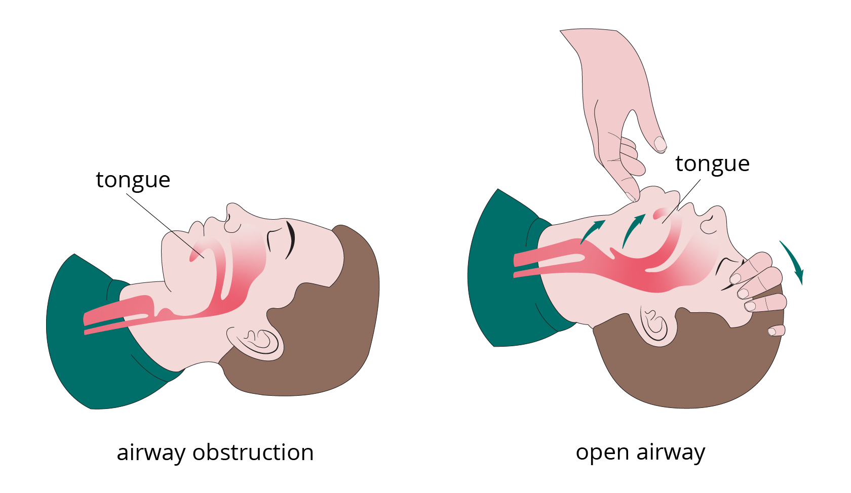 Opening the airway