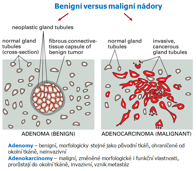 Benigní versus maligní nádory
