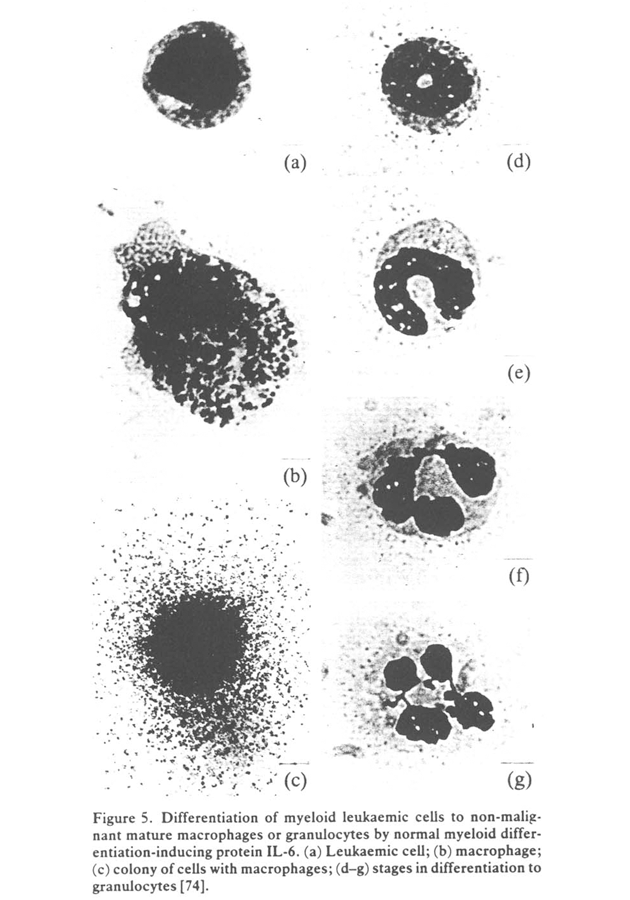Diferenciace myeloidních leukemických buněk do nemaligních zralých makrofágů nebo granulocytů interleukinem-6