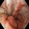 obraz refluxní esofagitidy