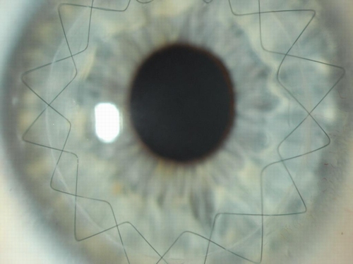 Obr. 54.: Aplikace krycí kontaktní čočky po keratoplastice