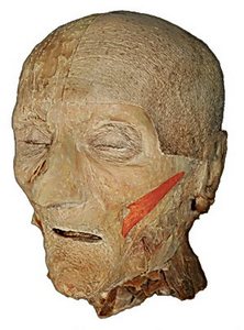 Vyznačení m. zygomaticus major pro anatomickou pitvu hlavy, výukové materiály MUDr. Ivany Hradilové Svíženské, CSc. (LF)